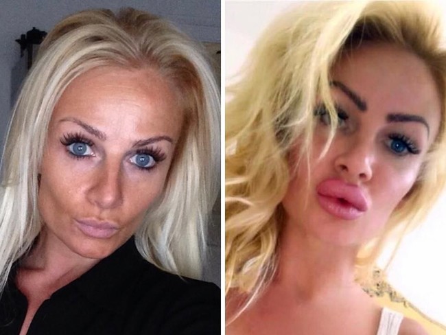 Perlu waktu dua tahun bagi Kerry sampai bibirnya kembali normal pasca suntik filler, yang prosedurnya dilakukan pada 2016 silam. Foto: Instagram/@uk.barbie