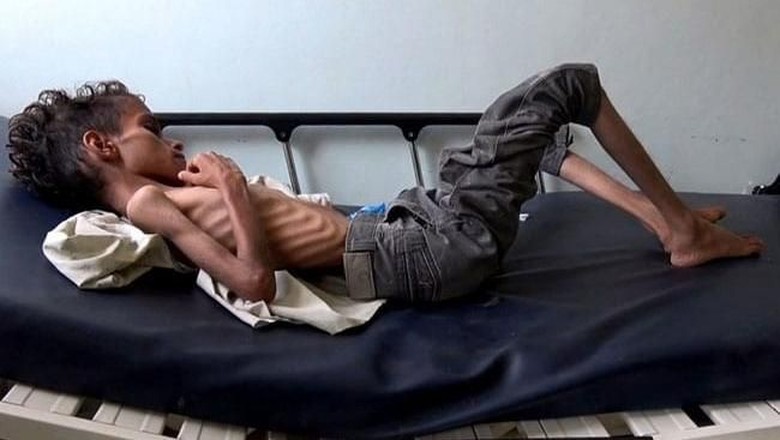 Kondisi Pilu Bocah Yaman Umur 10 Tahun yang Beratnya Hanya 8 Kg Kondisi Pilu Bocah Yaman Umur 10 Tahun yang Beratnya Hanya 8 Kg