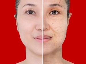 Cara Menghilangkan Jerawat di Wajah dalam Satu Minggu