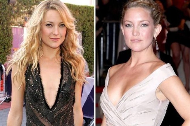 Dalam wawancara pada 2002, Kate Hudson mengaku bangga dengan payudaranya yang terbilang kecil. Aku punya dada yang sangat kecil. Itu sangat menyenangkan ketika menggunakan baju dengan belahan dada rendah karena terlihat elegan, ungkapnya di acara Golden Globes 2002. Kini, payudara bintang film Something Borrowed itu terlihat lebih berisi. Bisa dilihat dalam foto ini. Di awal kemunculannya, Kate memiliki dada yang terbilang rata. Sementara foto terbarunya, Kate tampak lebih seksi dengan bentuk dada yang lebih besar. Foto: Istimewa