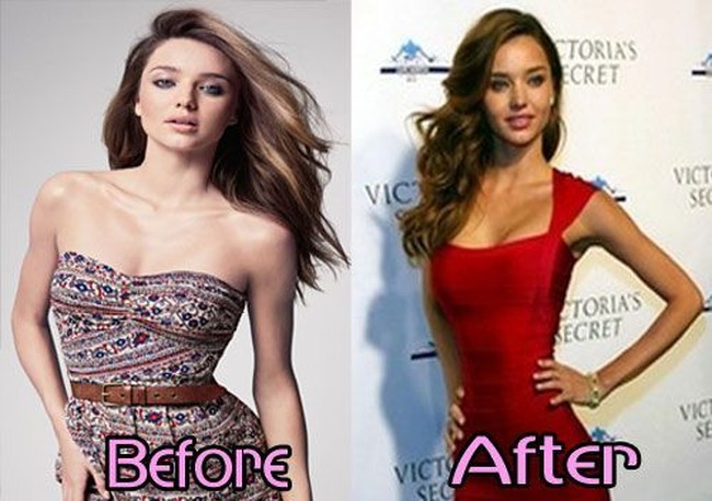 Dalam foto ini, jelas terlihat payudara Miranda Kerr dulu dan sekarang. Tidak disangka, mantan model lingerie Victorias Secret itu juga melakukan pemasangan implan payudara, meski ia tidak pernah membahasnya sama sekali. Foto: Istimewa