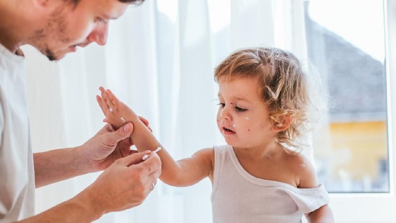 Ilustrasi gigitan nyamuk di kulit anak/ Foto: iStock Ilustrasi gigitan nyamuk di kulit anak/ Foto: iStock