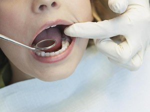 Meski Dipasang Permanen, Veneer Gigi Tetap Harus Dirawat