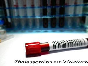 Thalasemia Hingga Hemofilia, Penyakit yang Risikonya Meningkat pada Incest