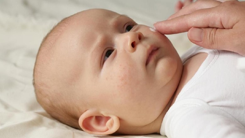 Ilustrasi bayi alergi/ Foto: iStock Ilustrasi bayi alergi/ Foto: iStock