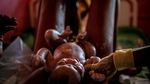 Perjuangan Anak-anak di Republik Afrika Tengah Lepas dari Gizi Buruk