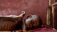 Gizi buruk menjadi salah satu penyakit yang masih terus diupayakan pengobatannya untuk anak-anak di Afrika Tengah. UNICEF/Ashley Gilbertson/VII Photo/Via Reuters.