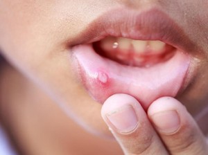 Sariawan Saat Berpuasa? Obati dengan 10 Bahan Alami Ini