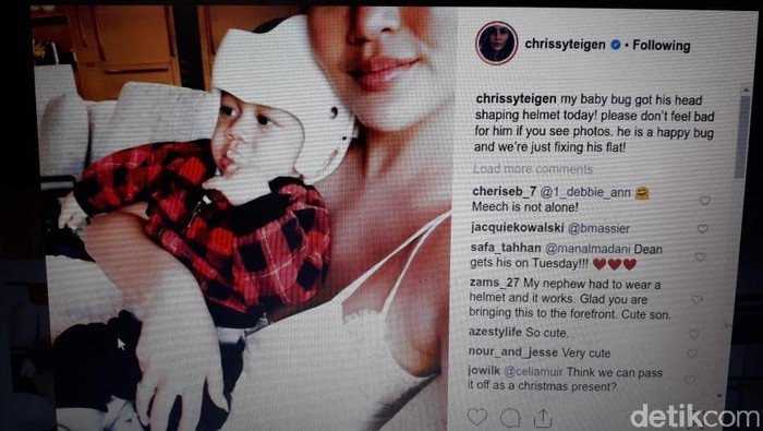 Anaknya Mengidap Plagiocephaly, Ini Pesan Menyentuh Model Chrissy Teigen