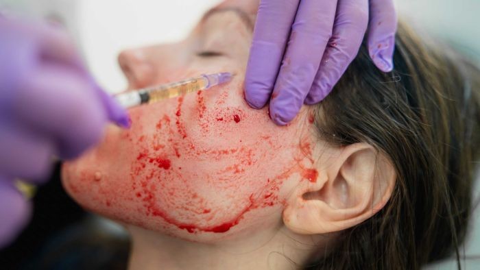 Wajah Awet Muda dengan Facial Drakula yang Juga Berisiko