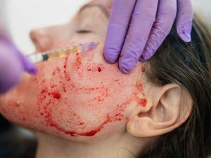 Wajah Awet Muda dengan Facial Drakula yang Juga Berisiko