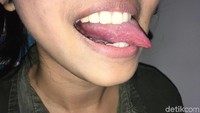 Pinggiran lidah juga menjadi lokasi kanker tumor terbanyak di Indonesia, menurut Dr drg Rahmi Amtha, SpPM. Cek pinggiran lidah kanan. (Foto: Frieda Isyana Putri/detikHealth) 