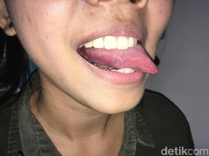 9 Obat Sariawan Alami Ini Bikin Kamu Bisa Makan Enak Lagi
