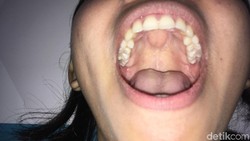64,9 persen kanker mulut bisa dicegah dengan deteksi dini. Begini langkah-langkah Periksa Mulut Sendiri atau SAMURI.