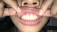 Jika penerangan kurang, bisa gunakan senter untuk mempermudah. Pertama-tama, cek gusi bagian atas. Carilah jika ada ciri-ciri lesi dalam bentuk sariawan atau tonjolan berwarna merah atau putih. (Foto: Frieda Isyana Putri/detikHealth)