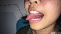 Pinggiran lidah kiri juga perlu dicek. Waspadai jika ada luka minor baik di lidah maupun di rongga mulut karena berpotensi memasukkan karsinogen ke pembuluh darah. Hindari faktor risiko utama seperti merokok, minum alkohol, menyirih dan seks oral yang berpotensi menularkan virus. (Foto: Frieda Isyana Putri/detikHealth)