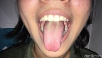 Periksa lidah secara keseluruhan. Apakah ada warna yang berbeda dari warna lidah, atau ada tonjolan yang seharusnya tidak ada di sana? Sebagian besar kasus kanker mulut berada di lidah, dan jika terlalu lanjut, pengidapnya harus merelakan lidah diangkat karena menjadi lokasi tumor. (Foto: Frieda Isyana Putri/detikHealth)