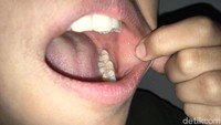 Cek bagian dalam pipi kiri, biasanya lesi merah atau putih muncul di sini. Perhatikan jika ada perubahan tekstur atau kekenyalan. (Foto: Frieda Isyana Putri/detikHealth)