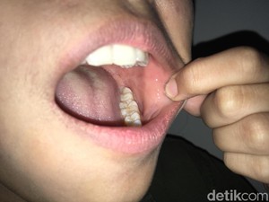 Gejala Baru COVID-19, Studi Temukan Ruam Mulut di Pasien Corona
