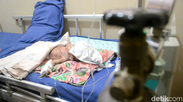 Bayi Kurang Gizi di Bone Mengidap Komplikasi TB Paru