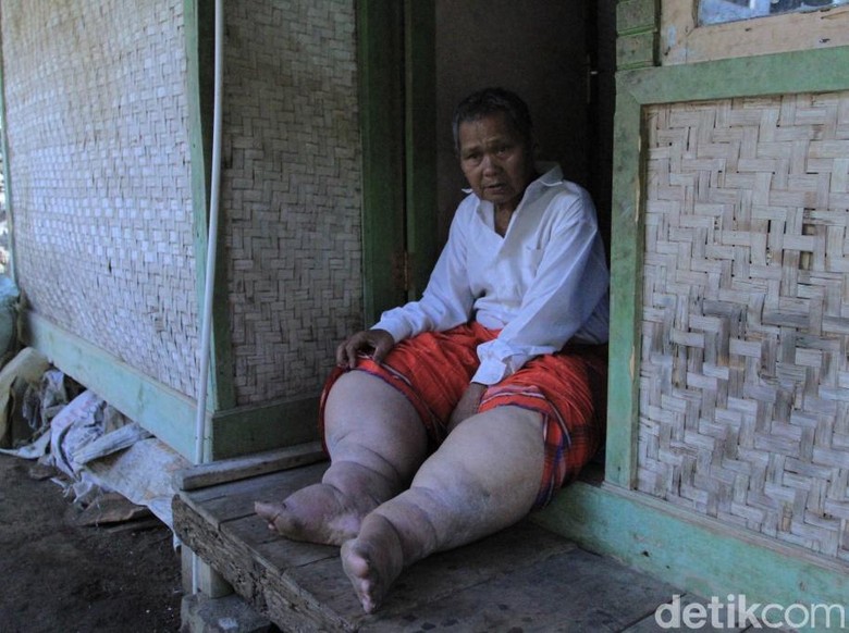 Sakit Kaki Gajah, Warga Sumedang Butuh Pengobatan dan Rutilahu Sakit Kaki Gajah, Warga Sumedang Butuh Pengobatan dan Rutilahu
