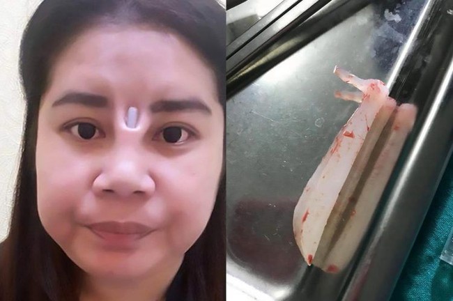 Wanita asal Thailand ini menyesal setelah melakukan rhinoplasty, atau bedah kosmetik untuk memperbaiki penampilan hidung. Prosedurnya melibatkan pemasangan implan silikon ke hidung dengan maksud untuk menciptakan tampilan yang lebih tegas. Setelah menjalani operasi, wanita tersebut menderita infeksi yang menyebabkan radang besar. Tubuhnya menolak prosedur itu, dan secara mengejutkan, implan tersebut muncul dari kulit di atas hidungnya. Foto: istimewa