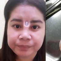 Wanita asal Thailand ini menyesal setelah melakukan rhinoplasty, atau bedah kosmetik untuk memperbaiki penampilan hidung. Prosedurnya melibatkan pemasangan implan silikon ke hidung dengan maksud untuk menciptakan tampilan yang lebih tegas. Setelah menjalani operasi, wanita tersebut menderita infeksi yang menyebabkan radang besar. Tubuhnya menolak prosedur itu, dan secara mengejutkan, implan tersebut muncul dari kulit di atas hidungnya. Foto: istimewa
