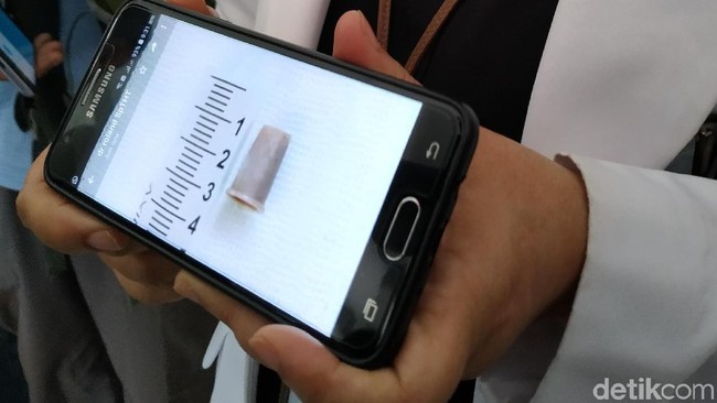 Benda-Benda Berbahaya yang Sering Tertelan, Peluit Hingga Gigi Palsu (2)