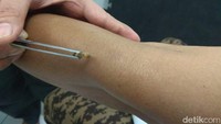 Lebah pun ditancapkan pada area yang dikeluhkan. (Foto: Aisyah Kamaliah/detikHealth)