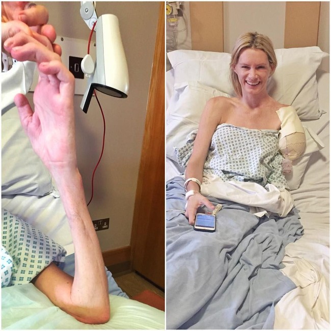 Kecelakaan yang terjadi di Afrika Selatan tahun 2015 tersebut mengharuskan tangannya diamputasi. Ketika itu, Olivia tengah melakukan adegan mengendarai motor dalam kondisi cuaca yang sedang hujan. Foto: Instagram @olivia_stunts