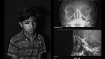 Camilo memotret Asif Ahmad Sheikh yang berusia 10 tahun dari Anantnag, Kashmir. Dia mengalami kebutaan setelah dipukul polisi saat hendak membeli permen. Foto: LensCulture