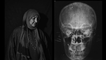 Tempat pertama di kategori Series diraih oleh Camillo Pasquarelli dari Italy. Karyanya bertajuk The Valley of Shadows menampilkan korban kekerasan yang membuat mereka hilang pengelihatan. Foto: LensCulture
