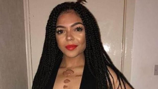 Cerita Miris Wanita yang Disuruh Bunuh Diri Karena Punya Keloid