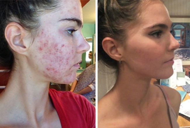 Dengan menjalani pola makan sehat itu, Nina dan Randa sukses memiliki kulit yang sehat. Selama masa remaja mereka, keduanya tidak mempunyai masalah dengan jerawat. Namun semuanya berubah ketika usia mereka mencapai 20 tahun. Tepatnya pada musim semi 2014, mereka bermasalah dengan wajah yang berjerawat. Jerawat yang muncul di wajah saudari kembar berusia 22 tahun itu bukan hanya jerawat kecil atau jerawat batu. Tapi keduanya mengalami masalah jerawat yang parah. Wajah mereka hampir dipenuhi jerawat kemerahan. Foto: Dok. Instagram