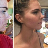 Dengan menjalani pola makan sehat itu, Nina dan Randa sukses memiliki kulit yang sehat. Selama masa remaja mereka, keduanya tidak mempunyai masalah dengan jerawat. Namun semuanya berubah ketika usia mereka mencapai 20 tahun. Tepatnya pada musim semi 2014, mereka bermasalah dengan wajah yang berjerawat. Jerawat yang muncul di wajah saudari kembar berusia 22 tahun itu bukan hanya jerawat kecil atau jerawat batu. Tapi keduanya mengalami masalah jerawat yang parah. Wajah mereka hampir dipenuhi jerawat kemerahan. Foto: Dok. Instagram