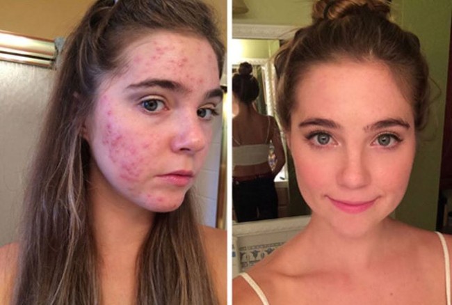 Dalam video yang diunggah ke You Tube, Nina dan Randa mengungkapkan bagaimana mereka sudah melakukan berbagai usaha demi menyembuhkan jerawat tersebut. Keduanya mengosumsi antibiotik, pergi ke beberapa ahli kulit hingga mencoba aneka jenis obat. Namun tak ada satupun dari metode pengobatan tersebut membuahkan hasil. “Kami berpikir, mungkin ada yang salah dari apa yang kami makan. Tapi apa? Kami tidak tahu. Apalagi kami sudah menjadi vegan,” ujar Randa. Foto: Dok. Instagram