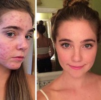 Dalam video yang diunggah ke You Tube, Nina dan Randa mengungkapkan bagaimana mereka sudah melakukan berbagai usaha demi menyembuhkan jerawat tersebut. Keduanya mengosumsi antibiotik, pergi ke beberapa ahli kulit hingga mencoba aneka jenis obat. Namun tak ada satupun dari metode pengobatan tersebut membuahkan hasil. “Kami berpikir, mungkin ada yang salah dari apa yang kami makan. Tapi apa? Kami tidak tahu. Apalagi kami sudah menjadi vegan,” ujar Randa. Foto: Dok. Instagram