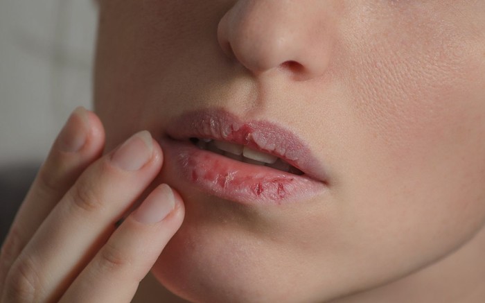 ilustrasi mulut Dermatillomania skin picking. Woman has bad habit to pick her lips. Harmful addiction based on anxiety stress and dry lips. Excoriation disorder. Sick cracked damaged tissue.