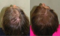 Pakar Rambut Rontok Terkejut dengan Serum Penumbuh Rambut Ini