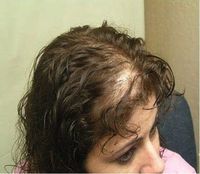 Pakar Rambut Rontok Terkejut dengan Serum Penumbuh Rambut Ini