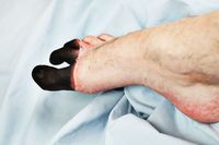 Jari kaki terkena frostbite (iStock)