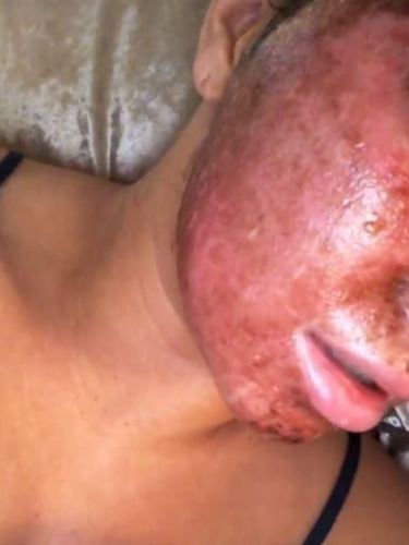 Wanita Ini Facial Rp 54 Juta, Usai Perawatan Wajahnya Jadi Mengerikan