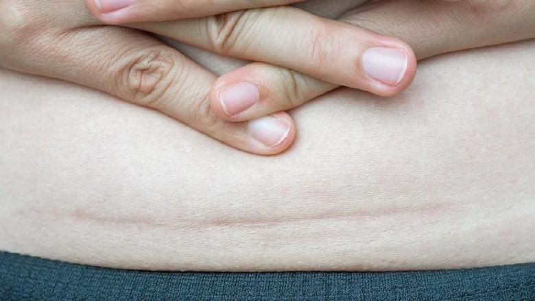 Sayatan operasi caesar/ Foto: iStock Sayatan operasi caesar/ Foto: iStock