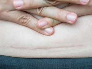 Ini 4 Cara Menyamarkan Bekas Luka Keloid Setelah Operasi Caesar