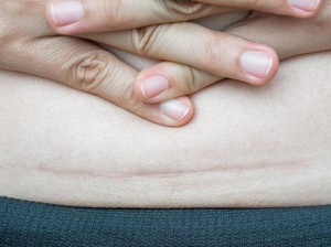 Ini 4 Cara Menyamarkan Bekas Luka Keloid Setelah Operasi Caesar