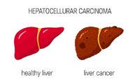 Gejala Mirip Hepatitis, Begini Membedakannya Dengan Kanker Hati