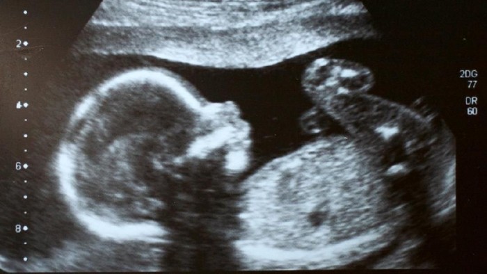3D Ultrasound image