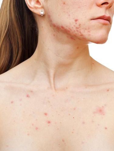 5 Efek Mengerikan Narkoba pada Kulit Wajah, Jangan Coba-Coba