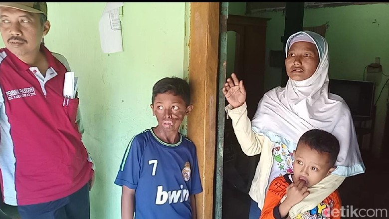 Cerita Samuel Saat Disiram Air Keras oleh Ayah Tiri Cerita Samuel Saat Disiram Air Keras oleh Ayah Tiri
