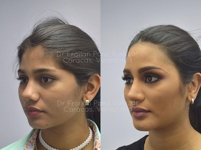 Foto-foto itu diunggah di Instagram oleh Froilan Paez, seorang dokter yang berspesialisasi dalam bedah hidung estetikan dan fungsional. Pada unggahannya itu Froilan memberikan keterangan dengan tagar #rhinoplasty, #mentoplasty, #otoplasty. Foto: Instagram @froilanpaez